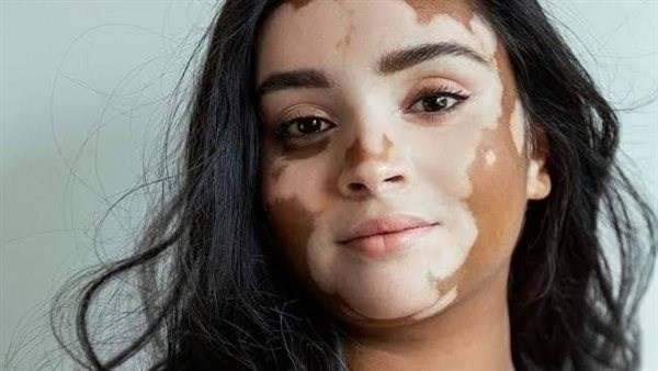  في اليوم الأول العالمي لمكافحة البهاق.. خرافات لا تصدقها 