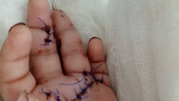 جامعة الزقازيق: نجاح زراعة أصابع رضيع مبتورة واستعادة وظيفتها بصورة كاملة| شاهد