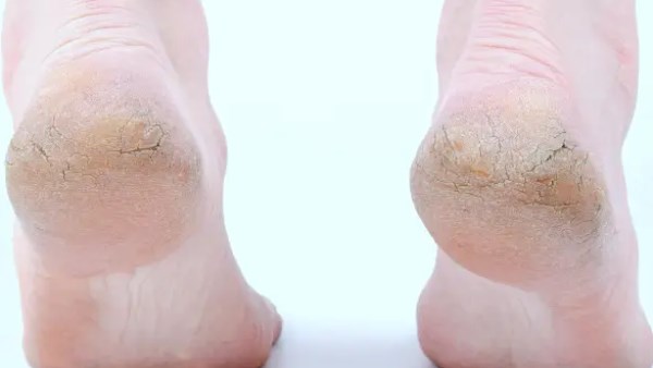 تشقق الكعبين.. الأسباب والأعراض وطرق الوقاية