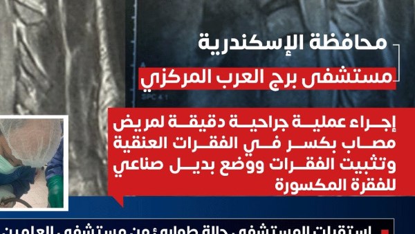 بديل صناعي لفقرة عنقية مكسورة