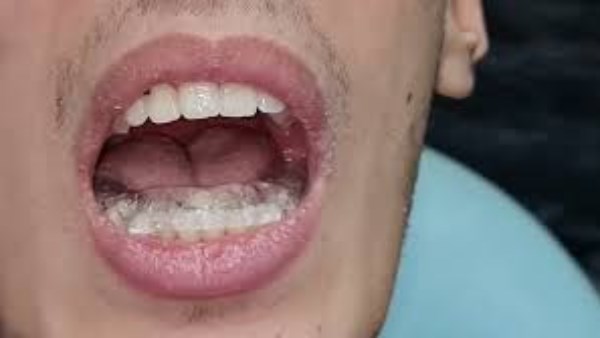 لا تفتح فمك قبل قراءة هذا! دليل التعامل مع مشاكل غضروف الفك 