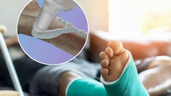 ابتكار طبي صيني.. لاصق عظام يعالج الكسور في دقائق دون جراحة 