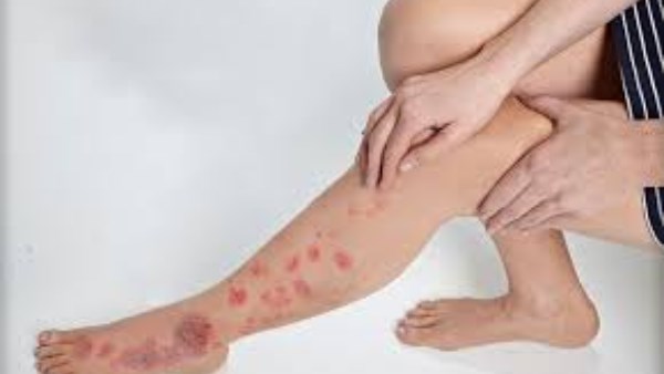 متلازمة هينوش شونلاين 