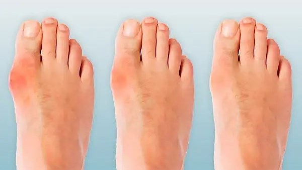 بروز عظمة القدم (الوكعة).. لماذا تحدث؟ وما طرق علاجها؟