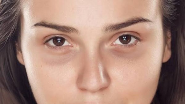 وصفات طبيعية للتخلص من الهالات السوداء