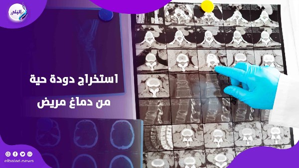 استخراج دودة حية من دماغ مريض