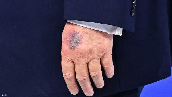 ترامب يوضح سبب ظهور كدمة على يده