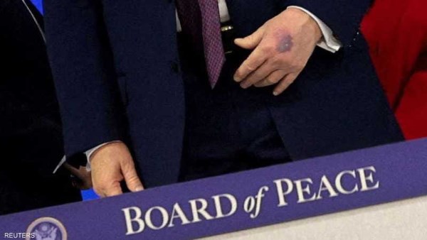 كدمة على يد ترامب 