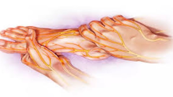 التهاب الأعصاب - أرشيفية 