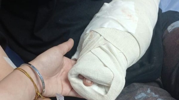 أثار الحادث على الفتاة