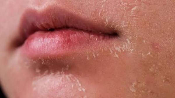 البشرة الجافة