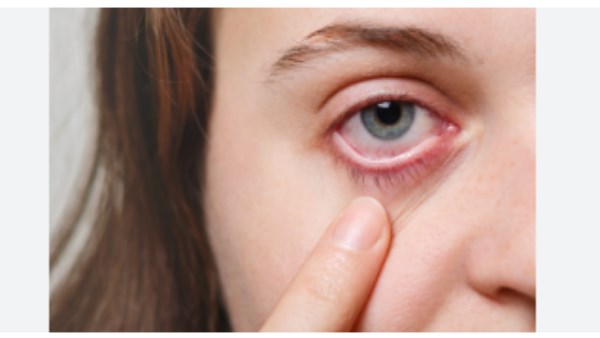 عينك بتحرقك في الشتاء .. كل ما تود معرفته عن جفاف العين عينك بتحرقك في الشتاء .. كل ما تود معرفته عن جفاف العين