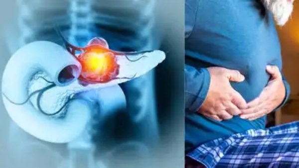 سرطان البنكرياس