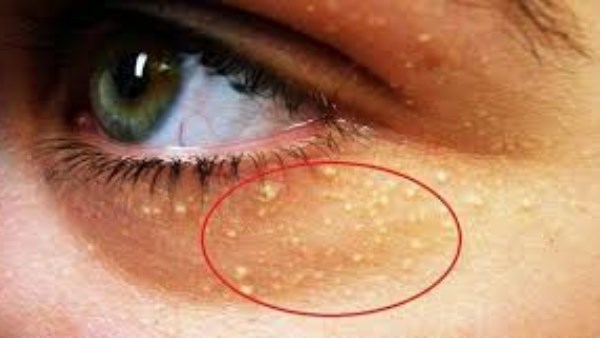 علامات خفية في الوجه تنذر بارتفاع الكوليسترول دون أن تشعر 