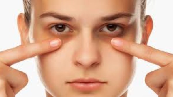 الهالات السوداء 