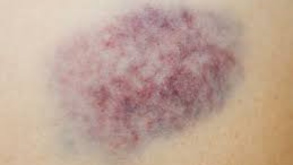 هل ظهور الكدمات المفاجئة ناقوس خطر يجب معالجته؟ 