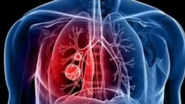 أعراض بسيطة بتبان عادية… لكنها أول إنذار لمرض خطير  