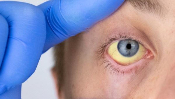  التهاب الكبد الوبائي.. الاعراض و طرق نقله و الوقايه منه