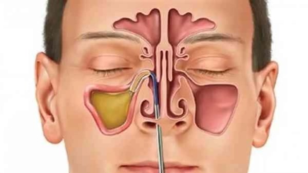  التهابات الجيوب الأنفيّة مابين أعراض واسباب