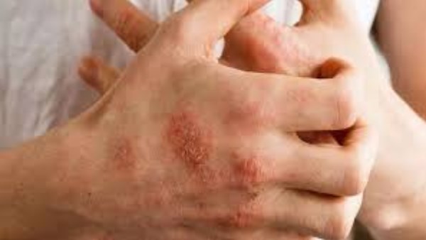 10 وصفات طبيعية لعلاج الإيكزيما
