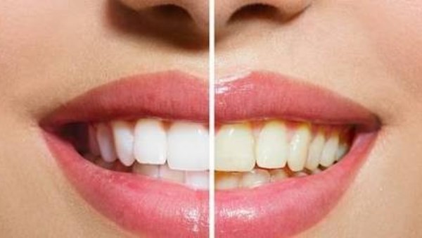 طرق طبيعية لتبييض الأسنان