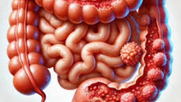 مضاعفات التهاب القولون التقرّحي.. مخاطر يجب الانتباه لها
