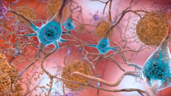 بروتين تاو.. الرابط بين كوفيد وألزهايمر