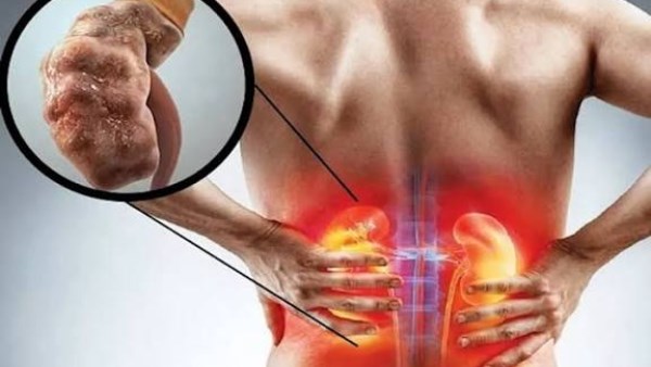 أعراض تلف الكلى