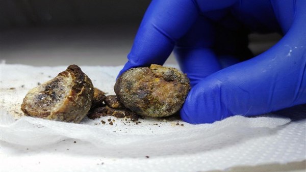 حصوات المرارة