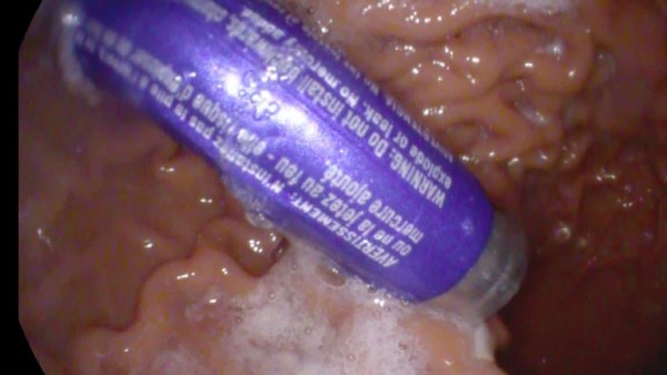 استخراج بطارية من بطن طفل فى بورسعيد 