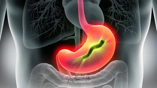 اعراض جرثومة المعدة 