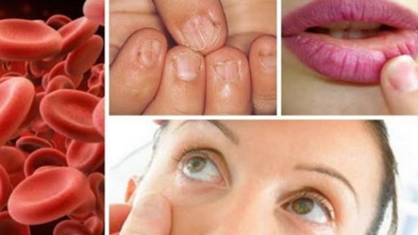 نقص الحديد عند النساء بين ضعف الامتصاص وخطأ العادات اليومية| تفاصيل 