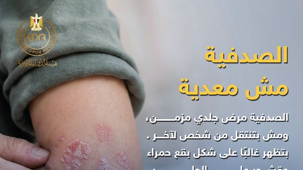 الصدفية 