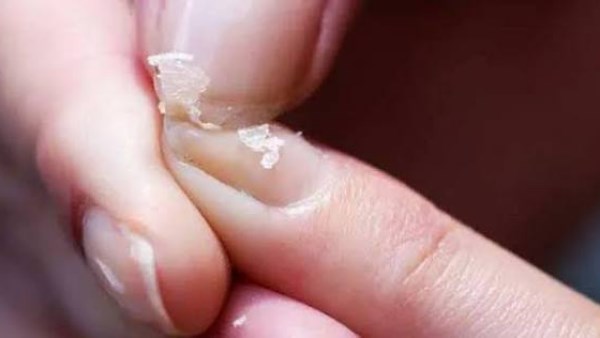 أعراض إذا ظهرت عليك قد تكشف نقص الكالسيوم.. طبيب يوضح 