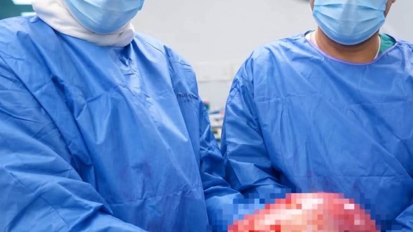 نجاح جراحة دقيقة لاستئصال ورم ليفي ضخم بوزن ٢٠ كجم بمستشفى سلام بورسعيد 