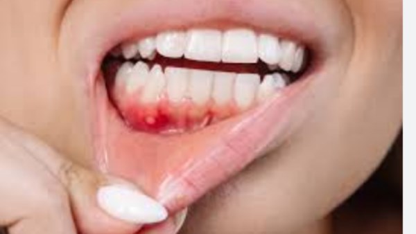  سرطان الفم والحلق 