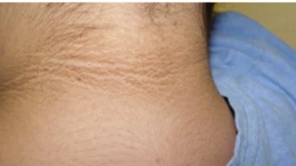 البقع الداكنة المخملية على الجلد 