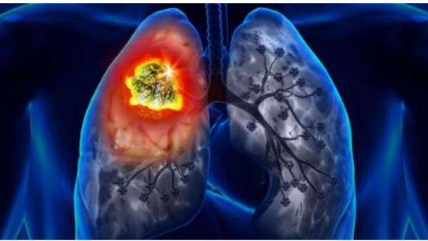 سرطان الرئة