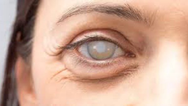 مياه بيضاء تهدد بصرك.. طبيب يفجر أسرار لم تخبرك بها العيون من قبل! 