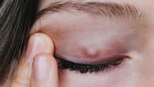 دمل العين .. أعراض شائعة ونصائح لتخفيف الألم