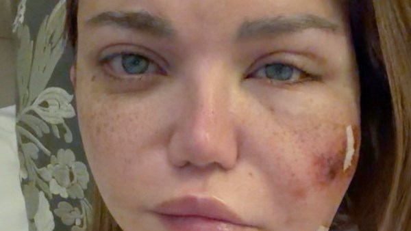 مرض ياسمين الخطيب.. الاسباب والاعراض لـ خراجات الوجه