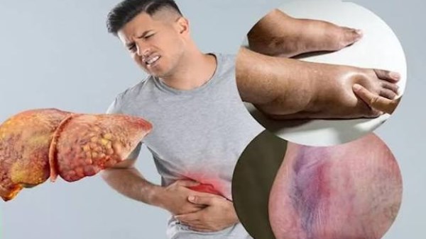 علامات وأعراض الكبد الدهني