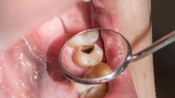 ما هو تسوس الأسنان؟