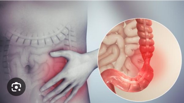 التهاب الأمعاء المزمن ليس مجرد التهاب بسيط
