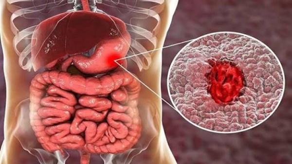 أعراض سرطان القولون والمستقيم