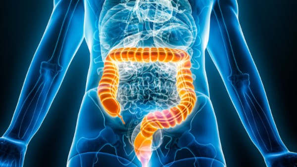 سبب إرتفاع الإصابة بسرطان القولون