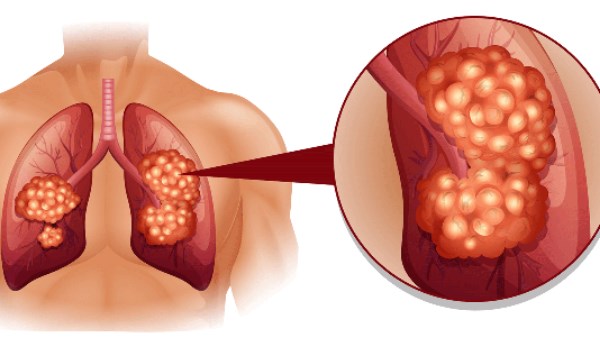 9 علامات مبكرة لسرطان الرئة.. لا تتجاهلها أبداً