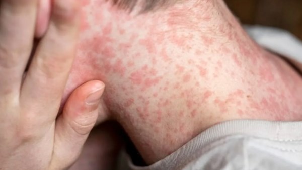 مرض شديد العدوى في إسرائيل