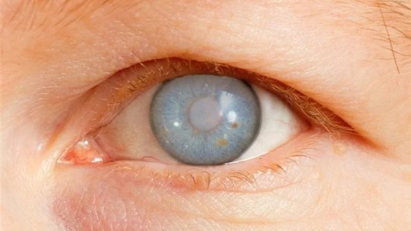 الجلوكوما .. مرض العين الصامت الذي قد يسرق البصر دون إنذار