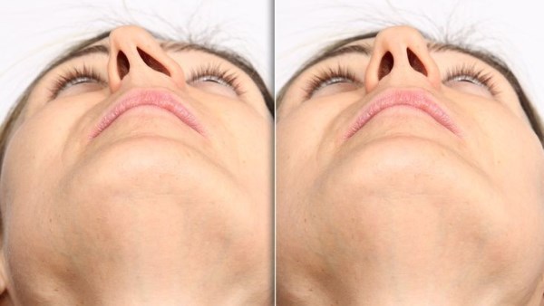  انحراف الحاجز الأنفي.. اسباب لا تتوقعها عن التشخر أثناء النوم